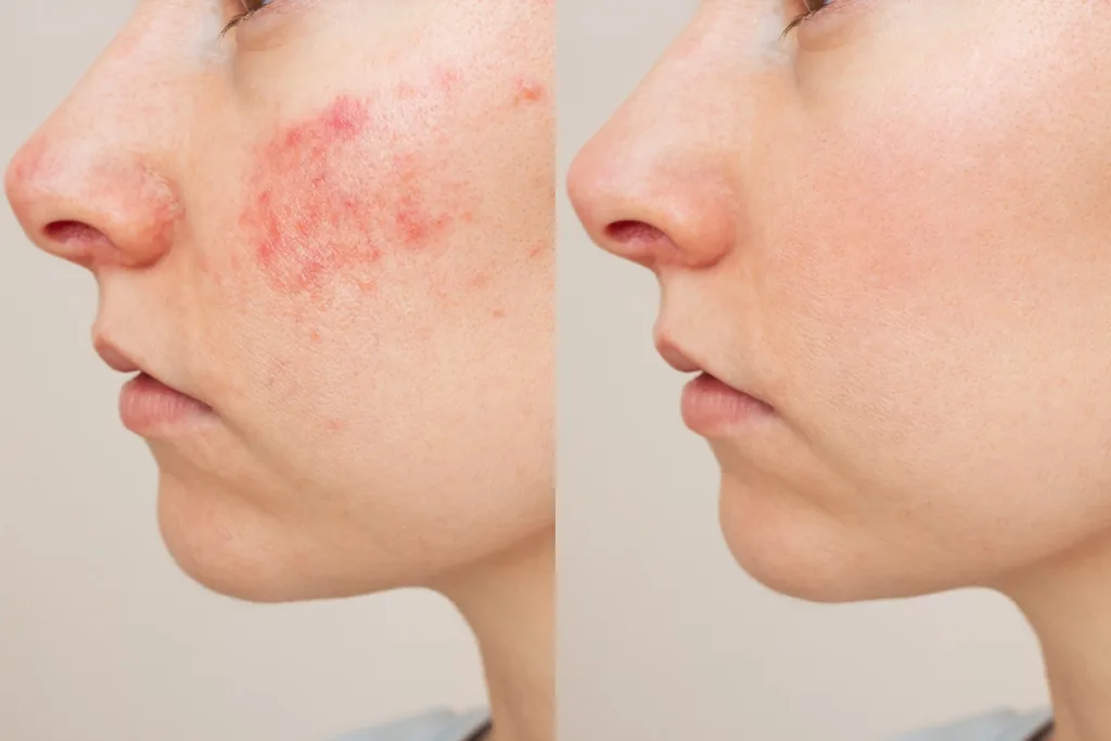 Before and after images of Vbeam laser treatment for rosacea