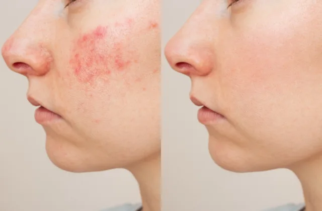 Before and after images of Vbeam laser treatment for rosacea