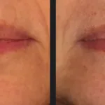Before and after photos for Vbeam laser birthmark treatment