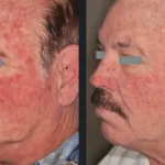 Before and after photos for Vbeam laser skin redness treatment