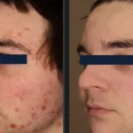 Before and after photos for Vbeam acne treatment