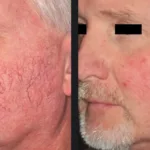 Before and after photos for Vbeam laser redness treatment