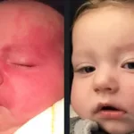 Before and after photos for Vbeam laser port wine stain treatment for infants