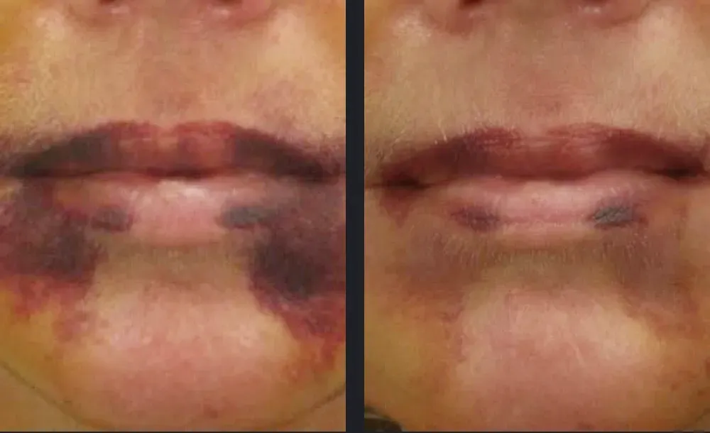 Before and after photos for Vbeam laser port wine stain treatment