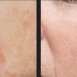 Before and after photos for Vbeam laser rosacea treatment
