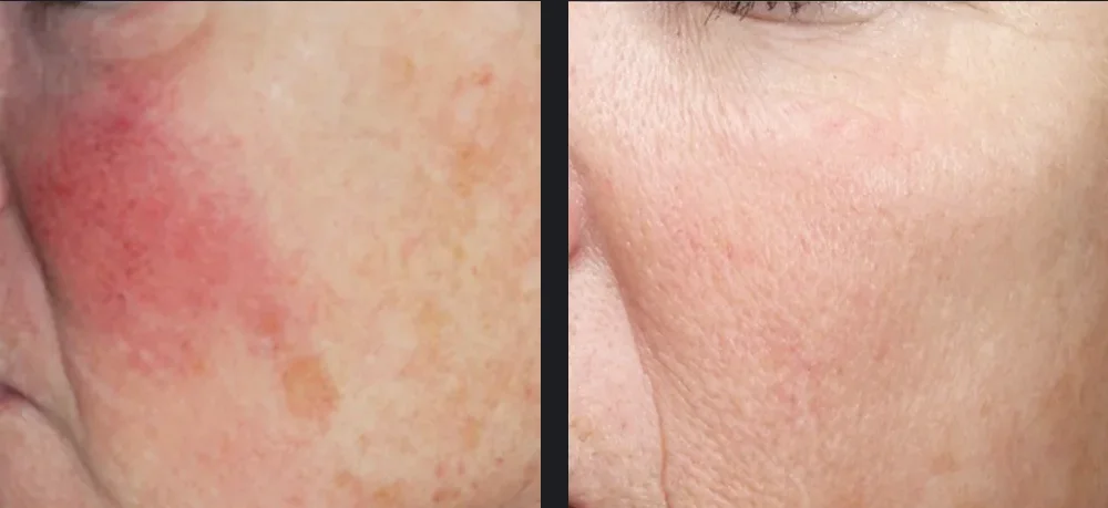 Before and after photos for Vbeam laser rosacea treatment