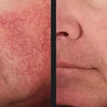 Before and after photos for Vbeam laser facial veins treatment