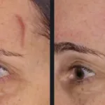 Before and after photos for Vbeam laser scar treatment