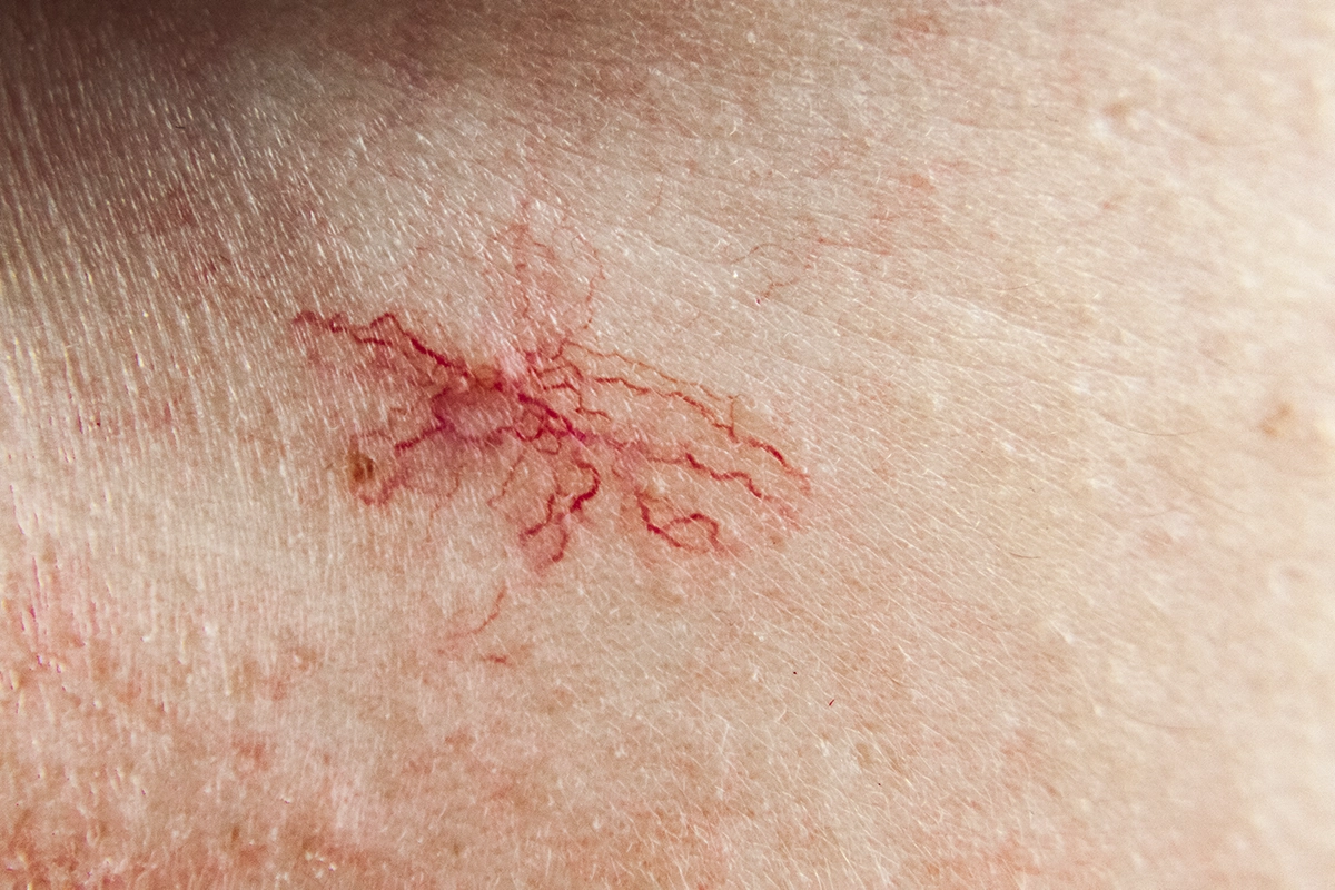 A close up of red spider veins or broken capillaries on the skin