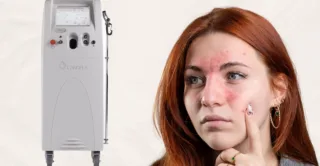 A graphic with a Vbeam laser machine next to a woman touching a finger to her rosacea, showing the concept of Vbeam laser treatments