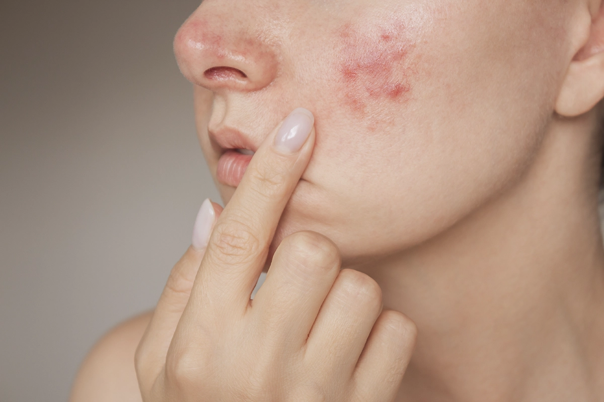 A woman points to rosacea on her face against a gray background