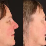 Rosacea: Before and 4 weeks After single VBeamPro treatment.