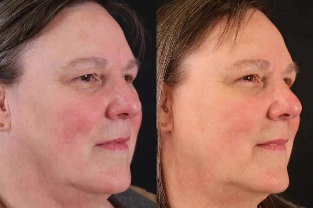 Rosacea: Before and 4 weeks After single VBeamPro treatment.