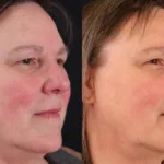 Rosacea: Before and 4 weeks After single VBeamPro treatment.