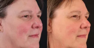 Rosacea: Before and 4 weeks After single VBeamPro treatment.
