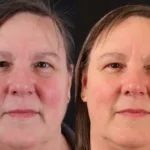 Rosacea: Before and 4 weeks After single VBeamPro treatment.